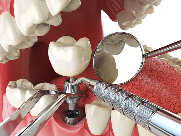 Best Urgent Care for Lost Fillings or Crowns in Grinnell, IA